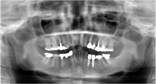 西本５　パノラマ像 装着後3ヶ月